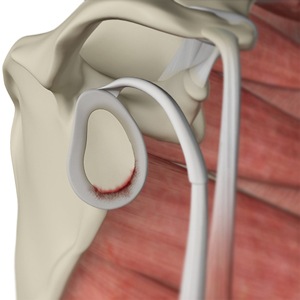 Shoulder Labral Tear